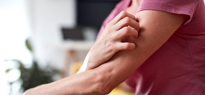 Birmingham woman with eczema or psoriasis