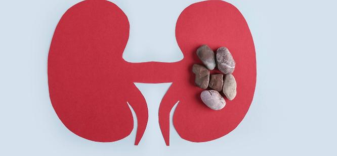 Kidney stones at urgent care