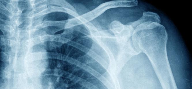 Shoulder xray from urgent care