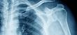 Shoulder xray from urgent care